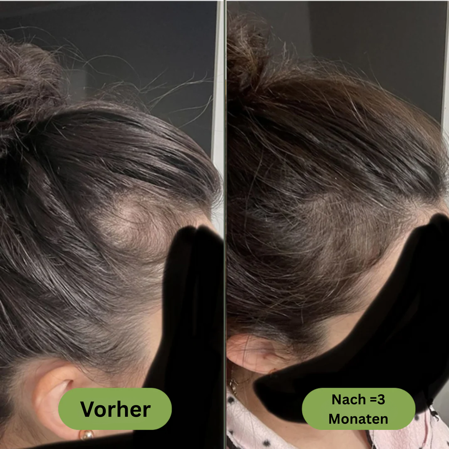 Royal Vital™ Botanisches 16 Öl Haarwuchsserum
